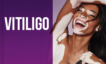 Vitiligo