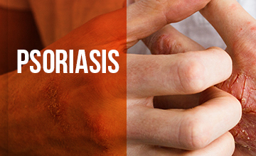 Psoriasis