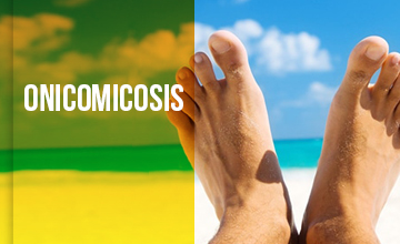 Onicomicosis