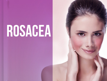 ROSACEA : MIDERMA CANNING