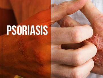 PSORIASIS : MIDERMA CANNING