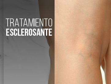 MIDERMA : TRATAMIENTOS CORPORALES : TRATAMIENTO ESCLEROSANTE